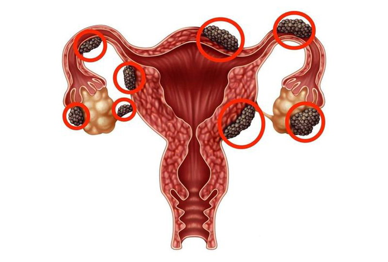 Endometriosis Treatment in Jaipur